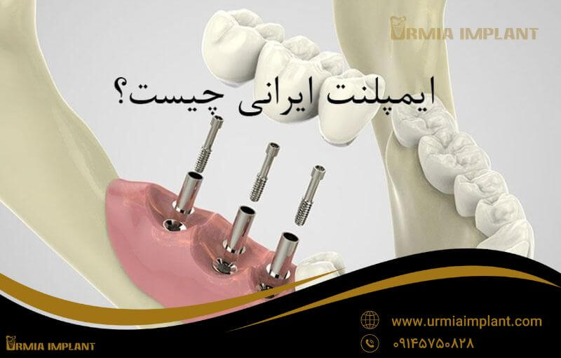 iranian implant urmiaimplant11.jpg