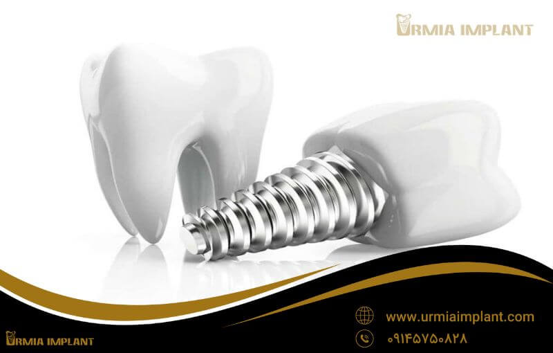 digital implant urmia1.jpg