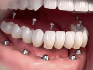فرق ایمپلنت با کاشت دندان