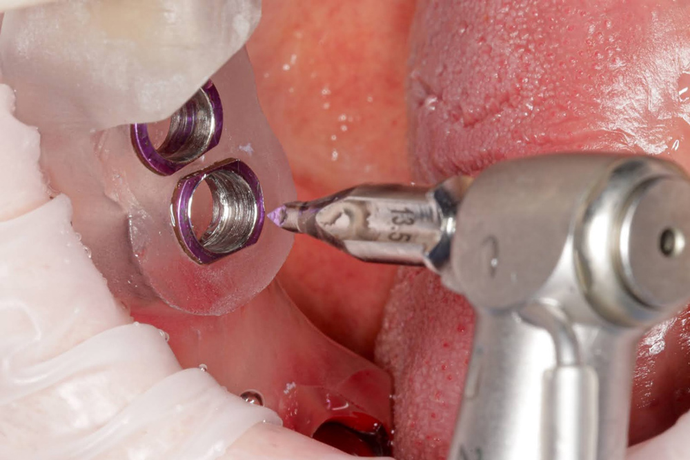 چه عواملی خطر عوارض ایمپلنت را افزایش می دهند؟