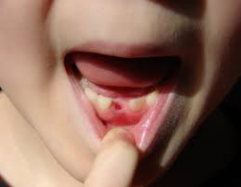 افتادن زود هنگام دندان شیری
