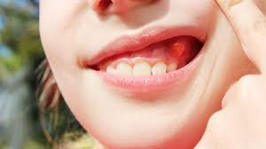 علائم کیست دندان
