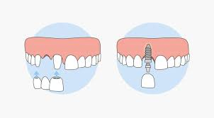 فرق ایمپلنت با پروتز دندان