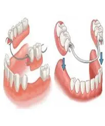 پروتز متحرک دندان