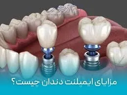 فواید و معایب ایمپلنت دندان