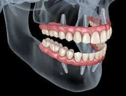 مزایای ایمپلنت تمام فک در ارومیه