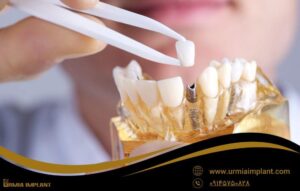خدمات اصلی مرکز ایمپلنت ارومیه
