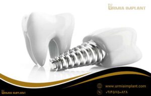 مزایای مرکز ایمپلنت ارومیه