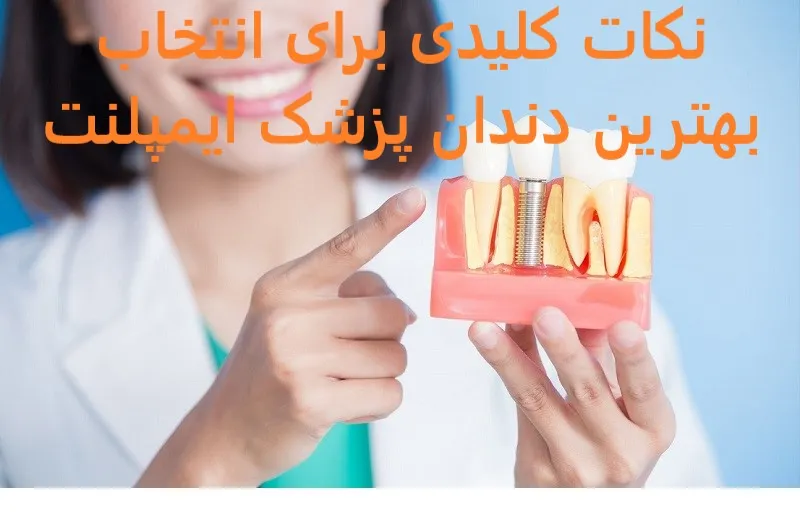 انتخاب بهترین دندان‌ پزشک ایمپلنت