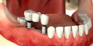 اجتناب از غذاهای سخت و چسبنده