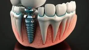 تکنیک‌های پیوند استخوان پیشرفته