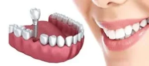 Psychological effects of implant treatment on patients2