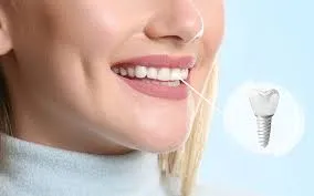 راهی به سوی لبخند زیبا ایمپلنت دندان