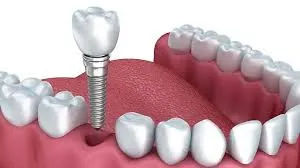 عفونت‌های پس از جراحی