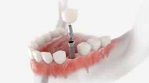 تأثیر بر کیفیت زندگی