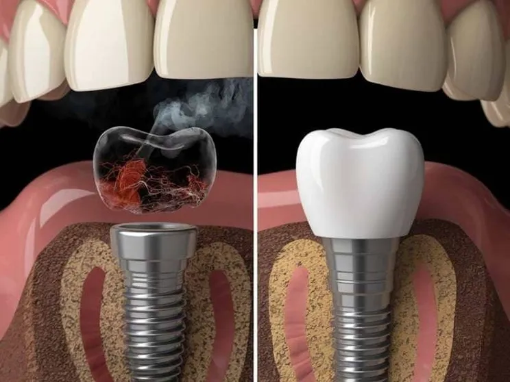تاثیر سیگار و قلیان بر موفقیت ایمپلنت دندان 2 تاثیر قلیان بر ایمپلنت دندان
