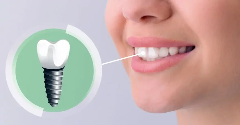 نقش روانشناسی لبخند در افزایش اعتماد به نفس بعد از ایمپلنت