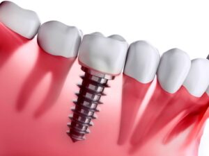 ایمپلنت دندان در سنین بالا؛ چالش‌ ها و مزایا