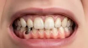 علل بوی بد دهان بعد از ایمپلنت