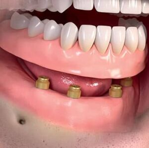 ایمپلنت تمام فک یا All-On-4 چیست و چه زمانی توصیه می شود؟ 2 مراحل انجام ایمپلنت All-On-4