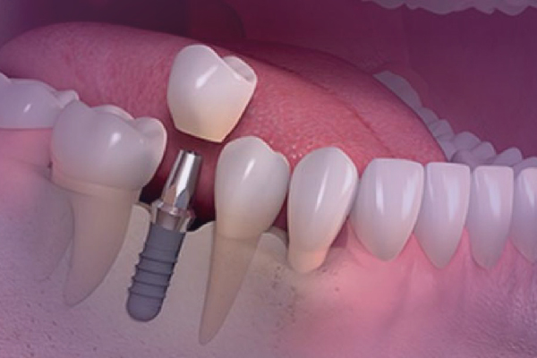 چگونه برای جراحی ایمپلنت آماده شویم
