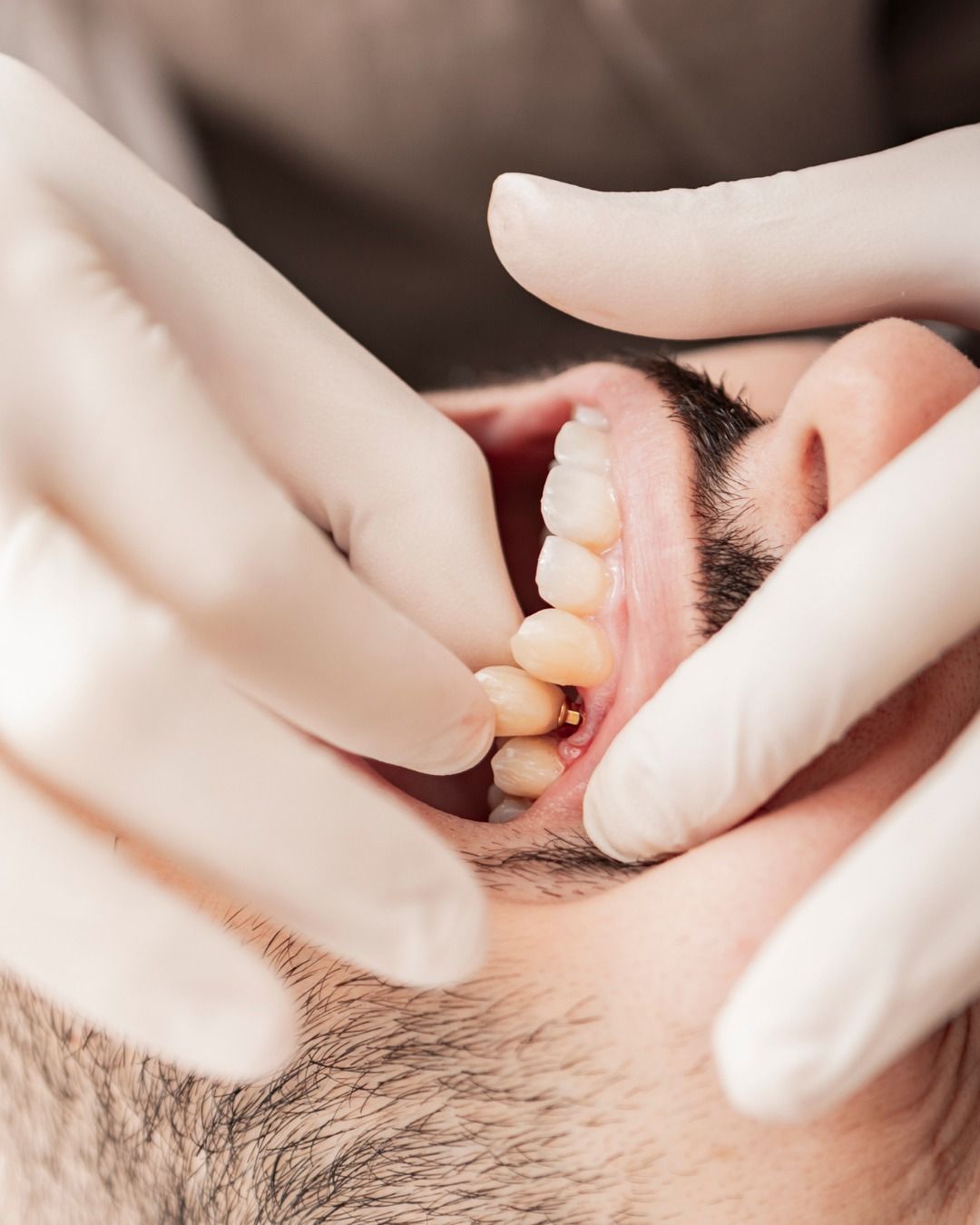 آیا ایمپلنت دندان برای همه مناسب است؟ — بررسی کامل شرایط انجام ایمپلنت دندان 1 ایمپلنت دندان چیست؟