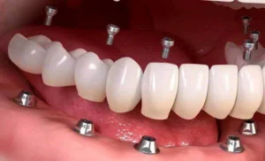ریکاوری سریع بعد از کاشت ایمپلنت با ۵ ترفند ساده 1 implant 01