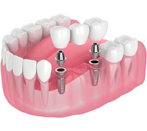 آیا ایمپلنت باعث آلرژی میشود ؟ 2 implant multiple teeth min