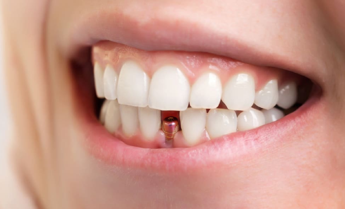 مراقبت از ایمپلنت دندان