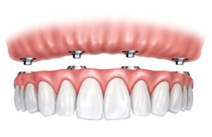 آیا ایمپلنت باعث آلرژی میشود ؟ 3 حساسیت به ایمپلنت: چه باید کرد؟