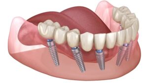 ایمپلنت یک مرحله‌ ای: تعریف و ویژگی‌ ها