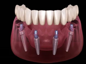 ایمپلنت دو مرحله‌ ای: تعریف و ویژگی‌ ها