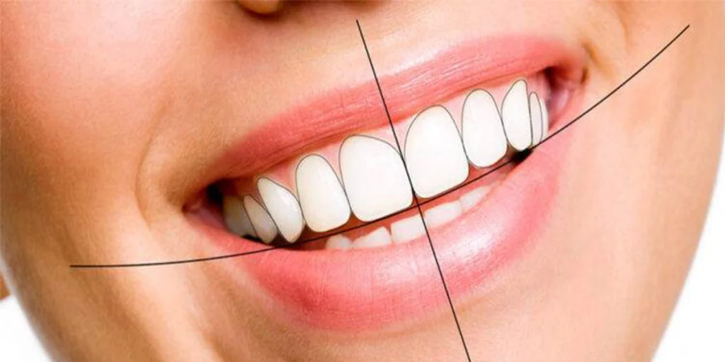 تصحیح خط لثه