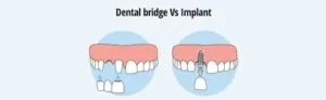 مقایسه ایمپلنت با بریج دندان؛ کدام گزینه مناسب شماست؟ 1 شناخت ایمپلنت دندان