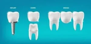 مقایسه ایمپلنت با بریج دندان؛ کدام گزینه مناسب شماست؟ 2 شناخت بریج دندان