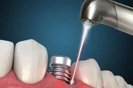ایمپلنت دندان لیزری چیست و چه مزایایی دارد؟ 1 تعریف ایمپلنت دندان لیزری