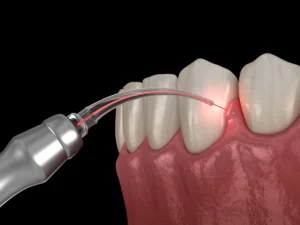 ایمپلنت دندان لیزری چیست و چه مزایایی دارد؟ 2 کاهش درد و ناراحتی
