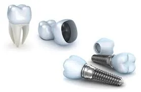 بررسی انواع برندهای ایمپلنت دندان