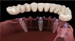 ایمپلنت چیست و چرا مهم است