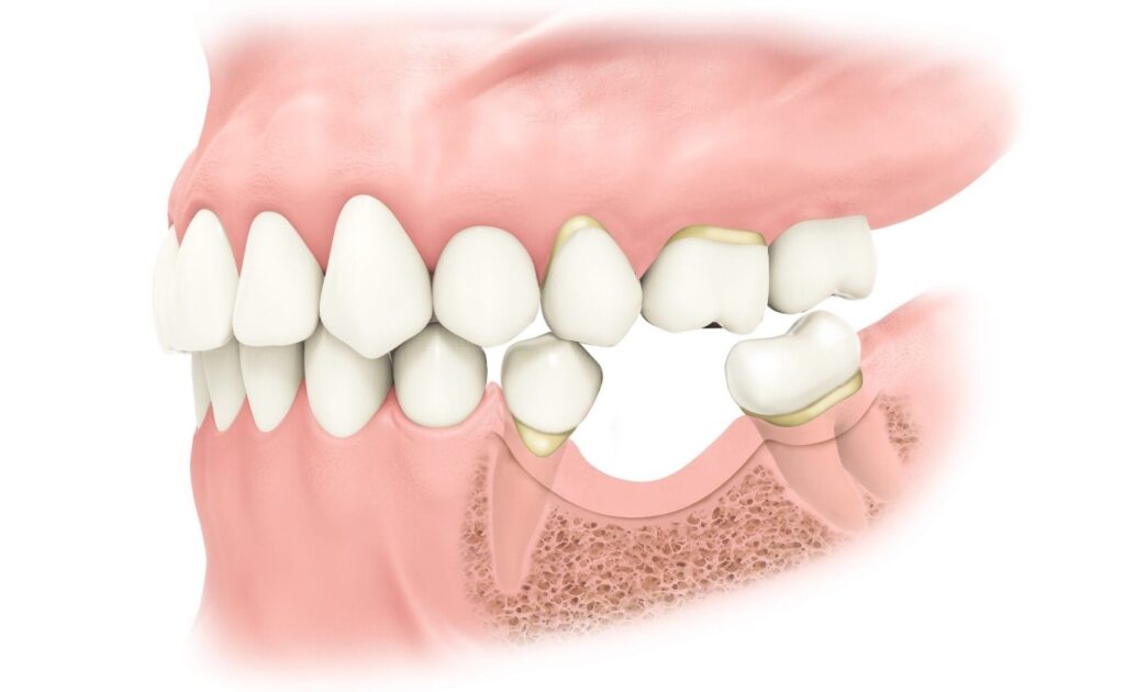 پروتکل های پیوند استخوان پیش از کاشت ایمپلنت: مقایسه مواد آلوگرافت، زنوگرافت و اتوگرافت 1 انواع مواد پیوند استخوان در ایمپلنت