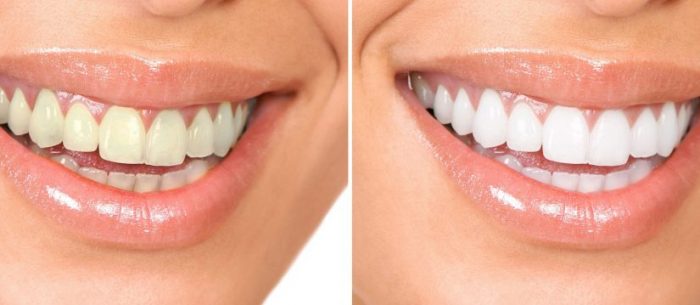 بازسازی کامل لبخند (Smile Design درمانی) 1 بازسازی کامل لبخند چیست ؟