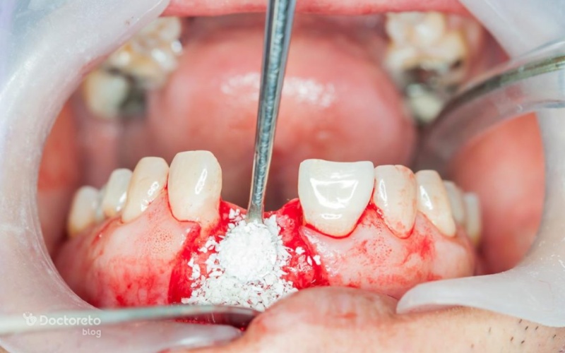 پروتکل های پیوند استخوان پیش از کاشت ایمپلنت: مقایسه مواد آلوگرافت، زنوگرافت و اتوگرافت 2 پروتکل های رایج پیوند استخوان پیش از کاشت ایمپلنت