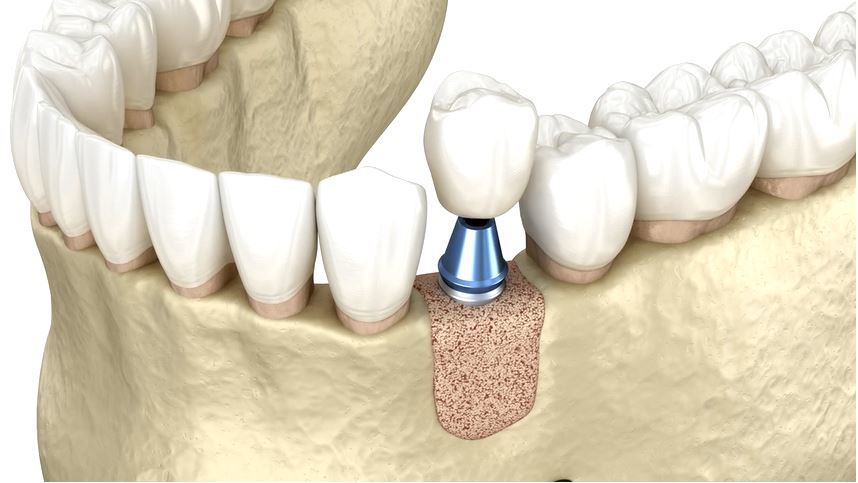 پیوند استخوان پیش از کاشت ایمپلنت