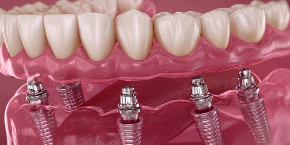 اوردنچر فک بالا بهتر است یا فک پایین؟