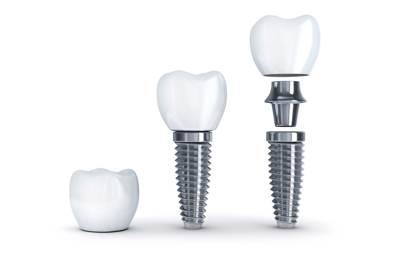 عمر ایمپلنت کره ای چقدر است | بررسی جامع ویژگی ها 4 مقایسه ایمپلنت کره ای با سایر برندها از نظر ماندگاری
