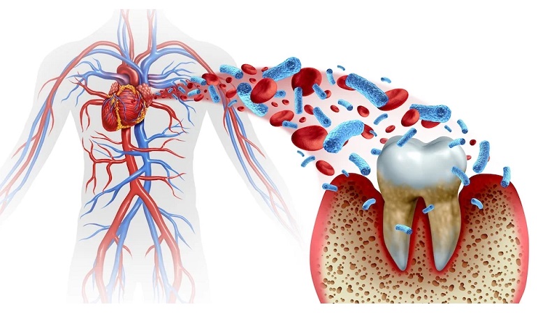 ایمپلنت در بیماران قلبی