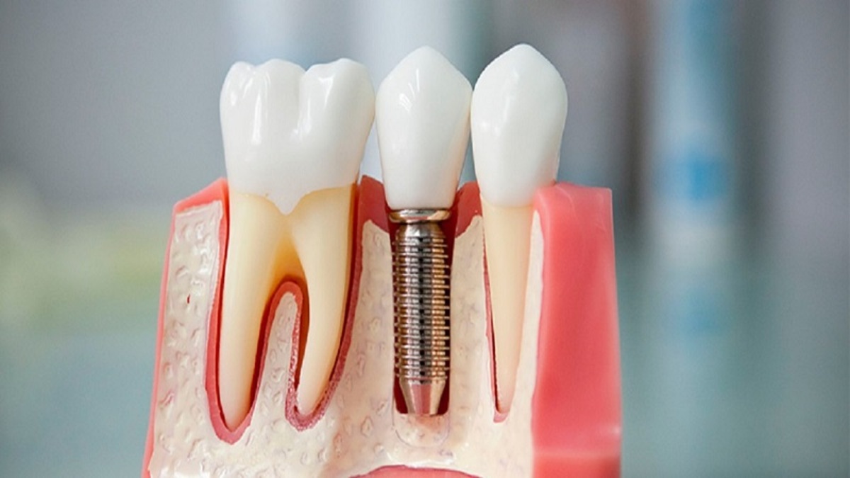 عمر ایمپلنت کره ای چقدر است | بررسی جامع ویژگی ها 1 عمر ایمپلنت کره ای به طور متوسط چند سال است؟