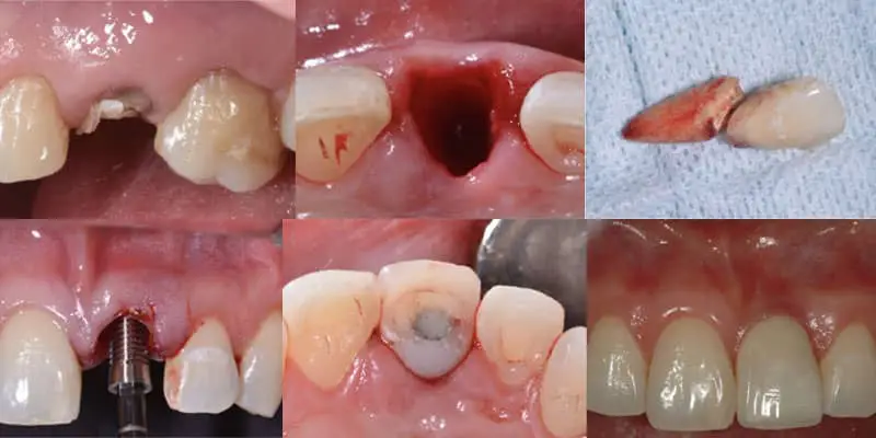ایمپلنت بعد از کشیدن دندان | ارومیه ایمپلنت 2 مراقبت های مهم بعد از کشیدن دندان قبل از ایمپلنت