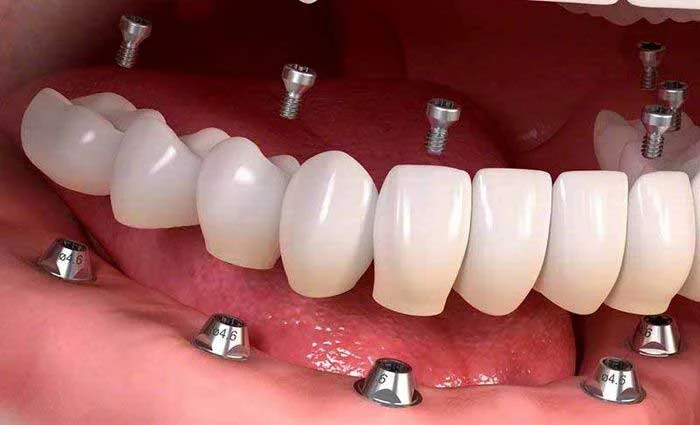 implant 01
