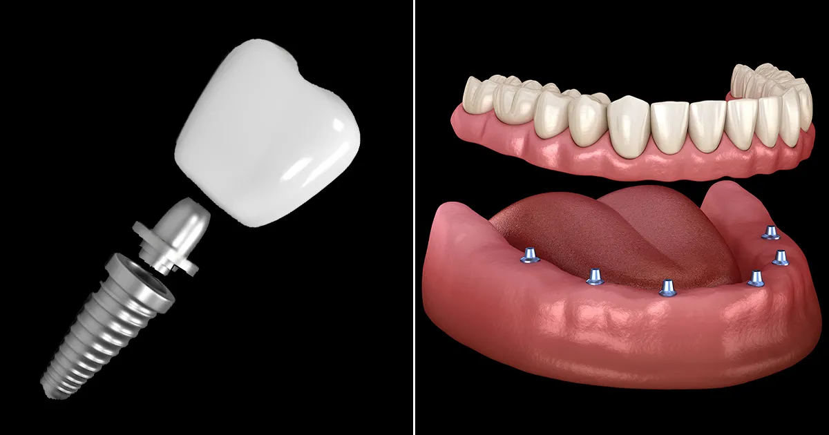 اصول درمان ایمپلنت در ناحیه بی دندانی تک واحدی